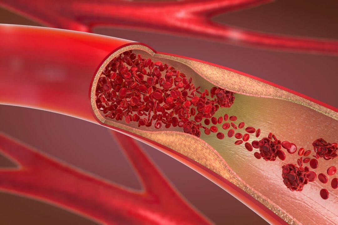 血管性阳痿如何治疗